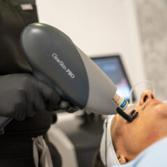 Skin Resurfacing - ClearSkin featured image