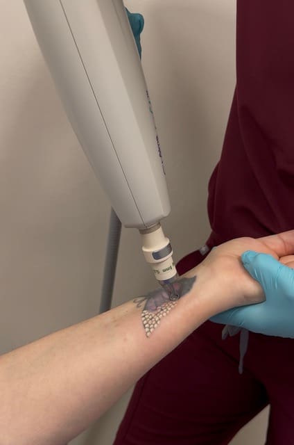 tattoo removal